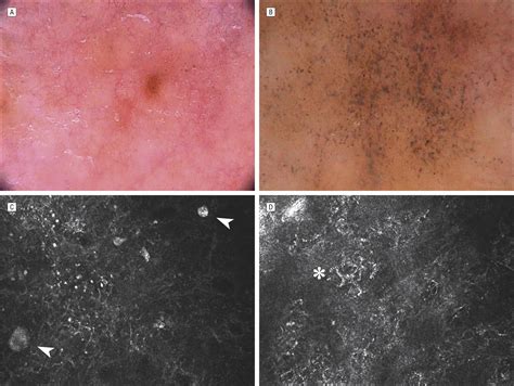 Pigmented Mammary Paget Disease Dermoscopic In Vivo Reflectance Mode