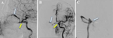 A Dsa Of The Right Internal Carotid Artery Ica In Lateral