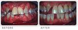 Photos of Non Surgical Periodontal Treatment