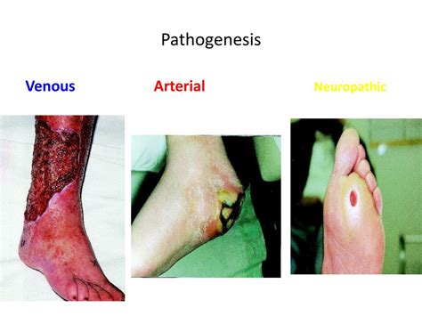Venous ulcer with characteristic features. PPT - FOOT ULCERS PowerPoint Presentation, free download ...