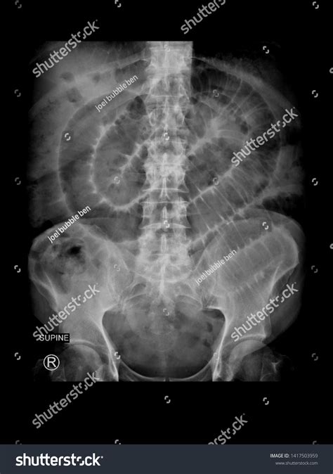 Film Xray Supine Abdomen Radiograph Show ภาพสต็อก 1417503959 Shutterstock