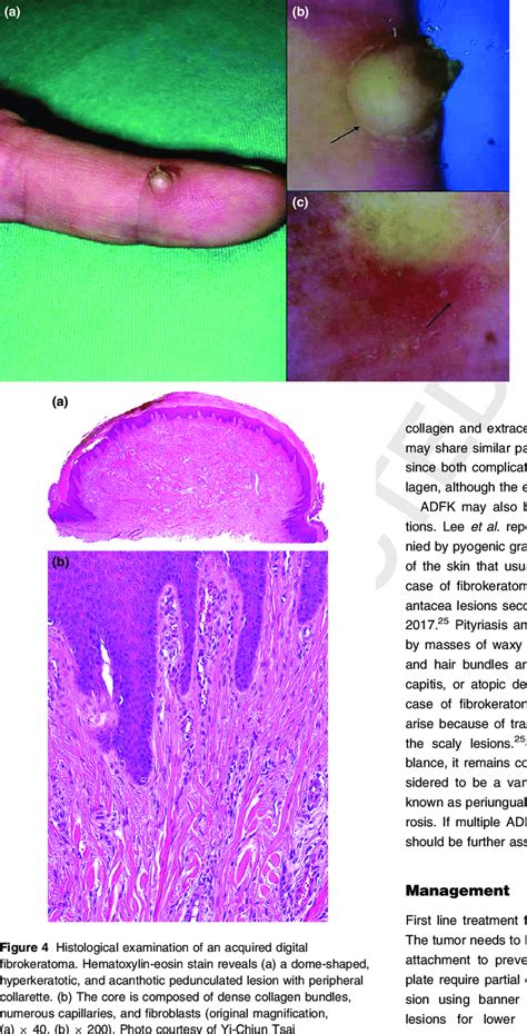 Dermoscopic Examination Of A An Acquired Digital Fibrokeratoma Shows
