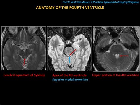 Figure 2 From Fourth Ventricle Masses A Practical Approach To Imaging