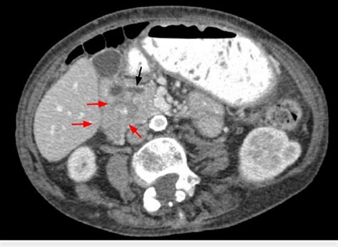 Ct Abdomen And Pelvis With Iv Contrast In Axial View Download