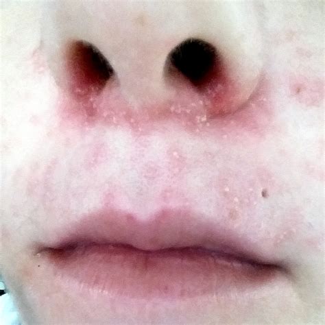 Collection 95 Pictures Herpes On The Nose Photos Stunning 102023