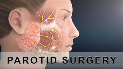 Parotid Surgery Animation Youtube