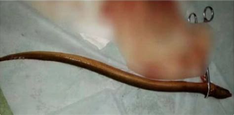 Chinese Man Inserts Live Eel Up Rectum To Cure Constipation Almost