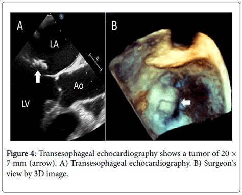 A Case Of Calcified Amorphous Tumor Found With Cerebral Infarction