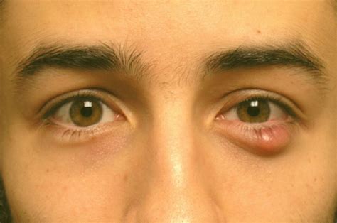 What Is An Eye Cyst Types Of Conjunctival Cystic Diseases