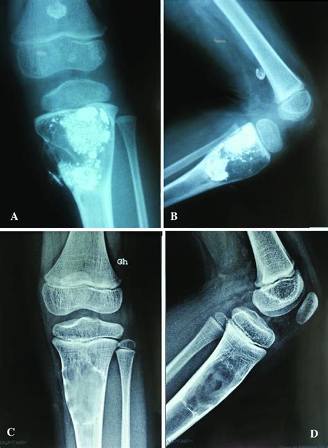 A And B Aneurysmal Bone Cyst Of Proximal Tibia Immediately After