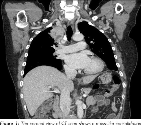 Figure 1 From A Case Of Invasive Pulmonary Aspergillosis In An