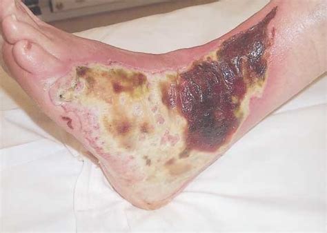These burns only affect the epidermis (the outermost layer of skin), and typically the often eschar (dry, black necrotic tissue) will form around the wound. Case 1 had a large burn on the lateral aspect of the left ...
