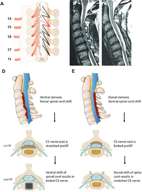 Illustration Of The Cervical Spinal Nerve Roots Exiting The Spinal Cord