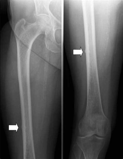 Ulna Hairline Fracture
