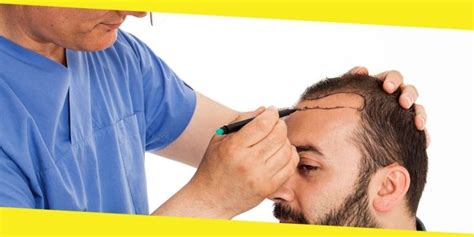 Turkey Hair Transplant An Overview
