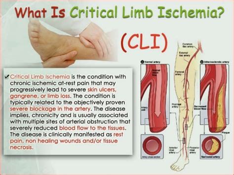 Critical Limb Ischemia Cli