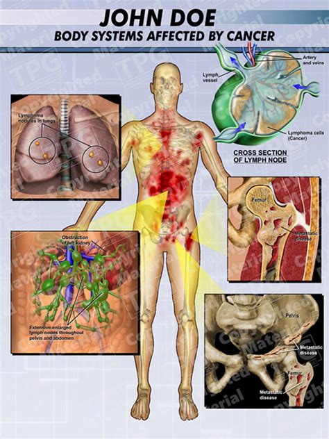 Body Systems Affected By Cancer Order