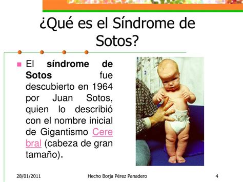 Ppt Síndrome De Sotos Powerpoint Presentation Free Download Id1812163