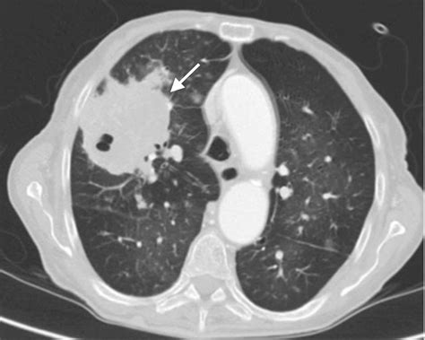 Cureus Invasive Pulmonary Aspergillosis In An Apparently