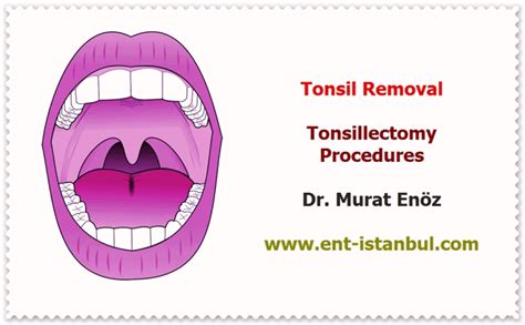 Tonsil Cancer Causes Symptoms Diagnosis And Treatment