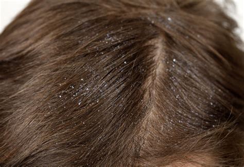 Lice Vs Dandruff Differences Pictures And Symptoms