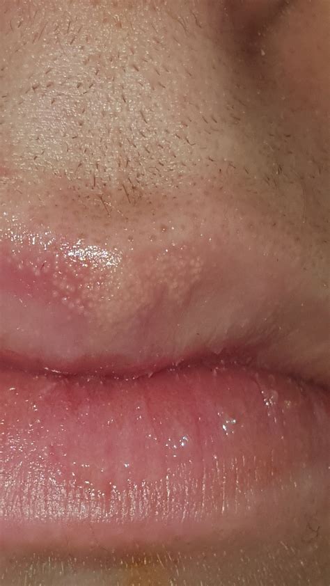 Skin Concerns M16 Cluster Of White Bubbles Inside Upper Lip