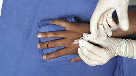 Peripheral Nerve Blocks For Hand Procedures Nejm