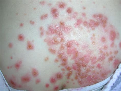 Impetigine Nei Bambini Foto Hd Sintomi Come Si Cura Youspecialist