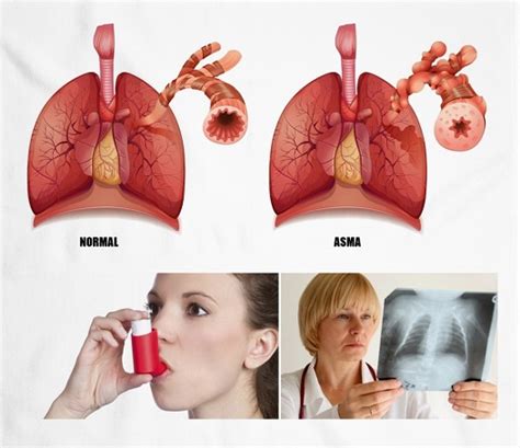Asma Causas S Ntomas Y Tratamientos