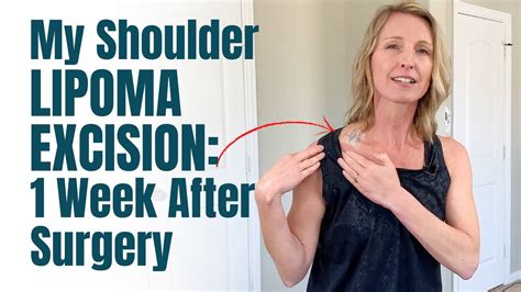 My Shoulder Lipoma Removal 1 Week Post Surgery YouTube