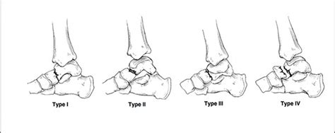 The Diagnosis Management And Complications Associated With Fractures