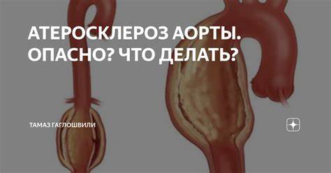 АТЕРОСКЛЕРОЗ АОРТЫ. ОПАСНО? ЧТО ДЕЛАТЬ? | Тамаз Гаглошвили | Дзен Картинка - АТЕРОСКЛЕРОЗ АОРТЫ. ОПАСНО? ЧТО ДЕЛАТЬ? | Тамаз Гаглошвили | Дзен