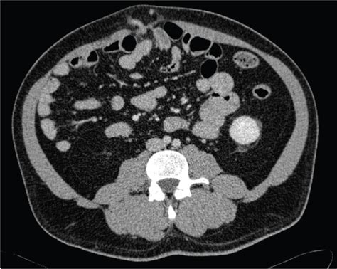 A Malrotated Incarcerated Appendix Within An Epigastric Hernia