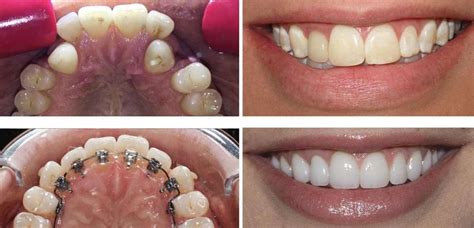 Differences Between Braces And Aligners By Stunning Dentistry