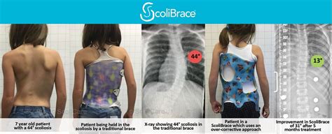 Case 5 Scolibracepreview Scoliosis Clinic Uk Treating Scoliosis