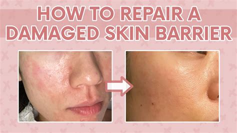 How To Heal A Damaged Skin Barrier 101 Tips To Repair A Damaged