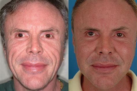sculptra treatment before and after photos dr bassichis