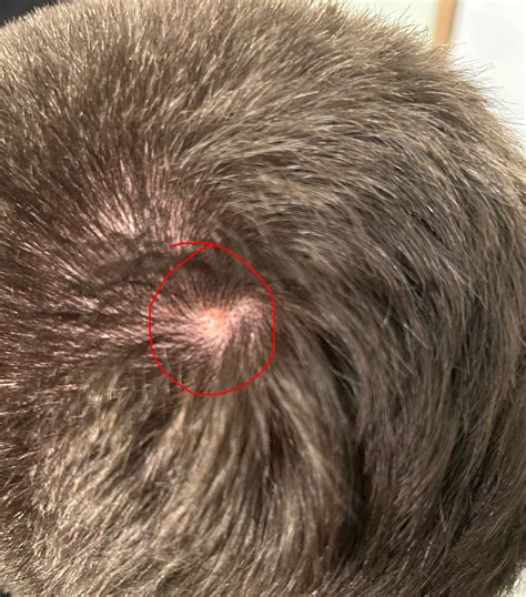 Raised Bump On Scalp What Could This Be Rdermatologyquestions