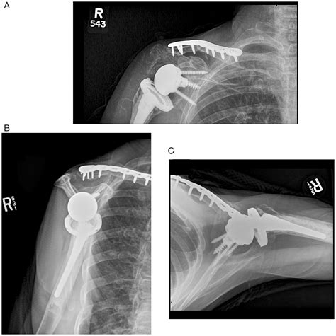 Scapular Notching Following Ipsilateral Traumatic Clavicle Fracture In