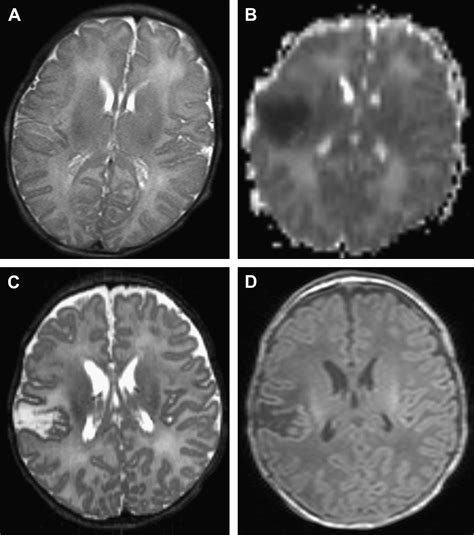 Evaluation And Management Of Stroke In The Neonate Clinics In