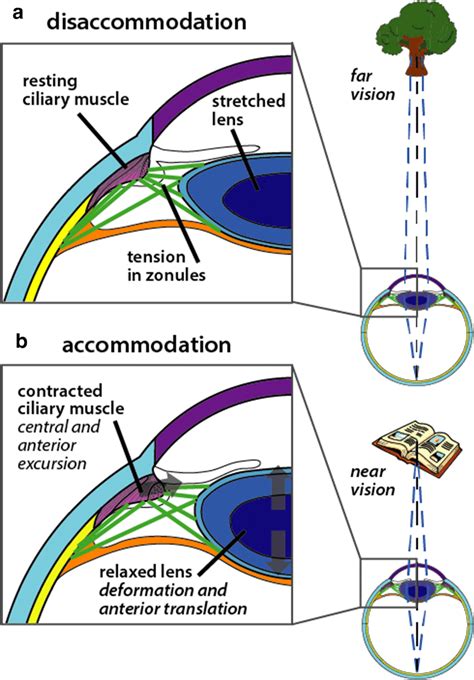 Diagram Of Accommodationa In Disaccommodation The Lens Is Stretched