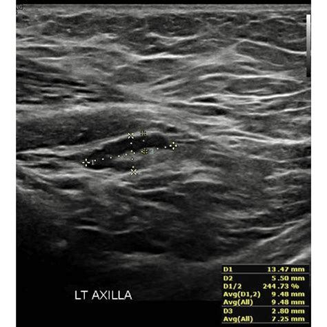 Cureus Sonographic Assessment Of Axillary Lymph Nodes Post Covid 19