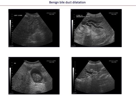 Benign Bile Duct Dilatation Ultrasound Images Download Scientific