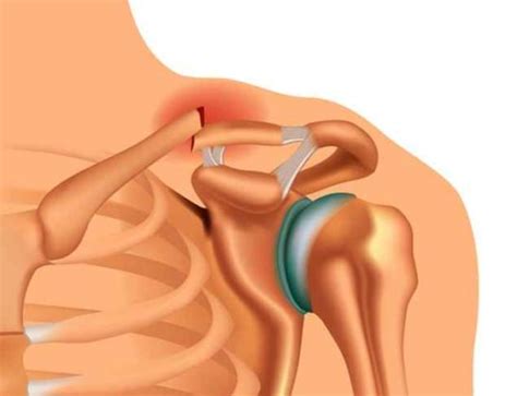 14 Common Causes Of Collarbone Pain And How To Treat Them
