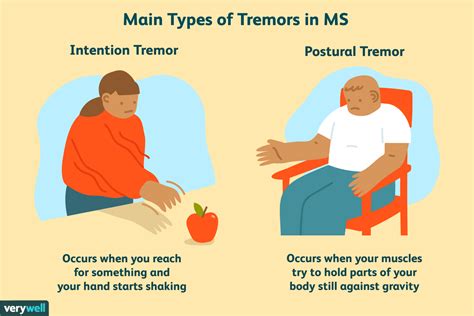 Tremor Als Symptoom Van Multiple Sclerose Med Nl