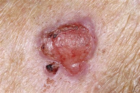 Skin Cancer Squamous Cell Carcinoma Stock Image M1310747