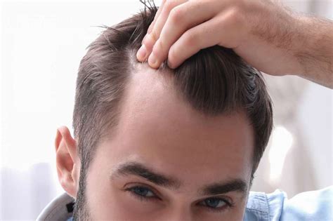 6 Fix Receding Hairline Article