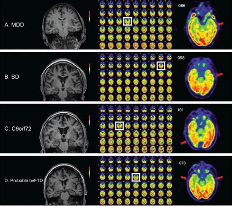 Diagnostic Accuracy of MRI and Additional [ 18F]FDG-PET for Behavioral ...