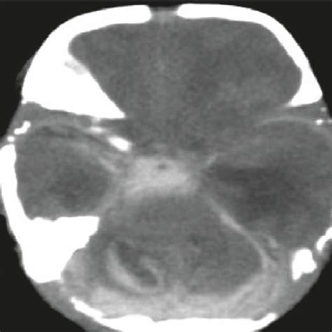Brain Computed Tomography Image Showing Subarachnoid Hemorrhage And