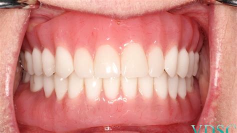 Process For Getting Immediate Dentures Newark67com